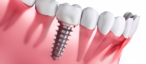 How To Heal Faster After Dental Implants