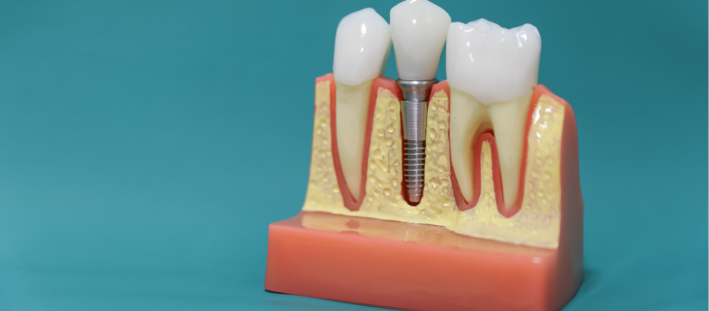 5 Signs of A Candidate for Dental Implants